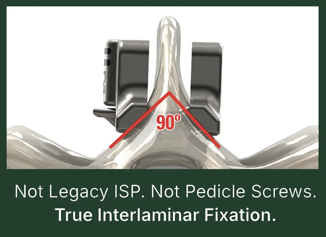 StabiLink MIS Interlaminar Fixation device on a lumbar spine model at a 90-degree angle — Not Legacy ISP. Not Pedicle Screws. True Interlaminar Fixation.